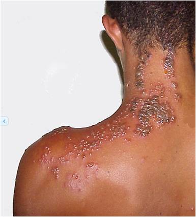 Left sides herpes zoster infection of the back of neck, shoulder and back. 