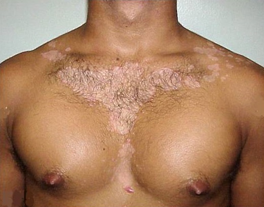 Appearance of Seborrheic eczema on the upper front chest of a black African woman