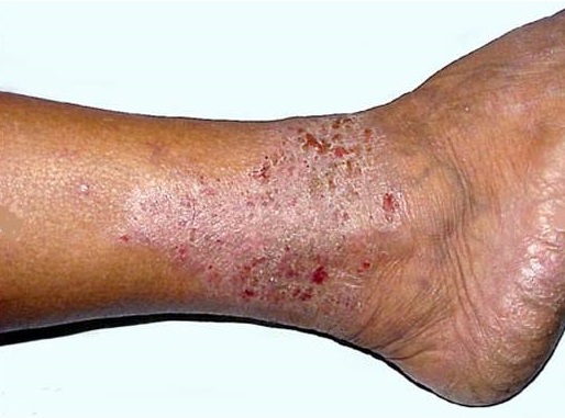 Stasis dermatitis of the right ankle of a black African woman