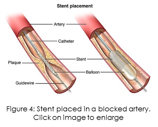 Stent olaced in a blocked artery