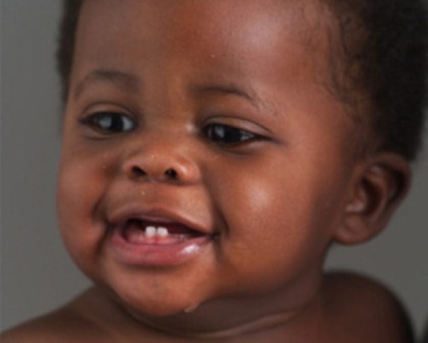 African baby with first set of erupting teeth