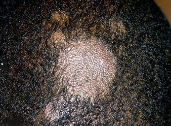 Tinea capitis (Scalp ringworm)