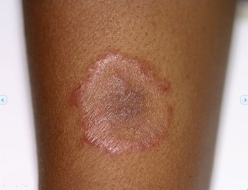 Tinea corporis (Ringworm)