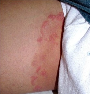 Tinea cruris (Jock itch)