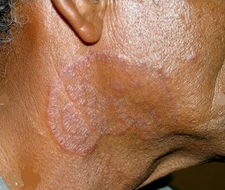 Tinea faciei (Face)