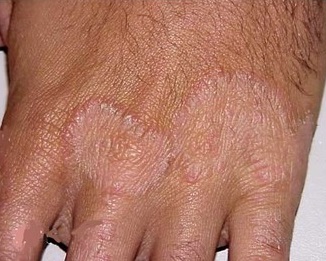 Tinea manuum (Hand)