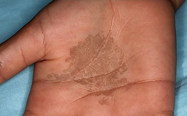 Tinea nigra (Palm of hand and Sole of feet)