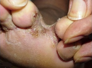 Tinea pedis (Athlete's foot)