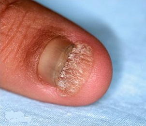 Tinea unguium (Nail)