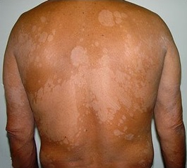 Tinea versicolor (Pityriasis versicolor)