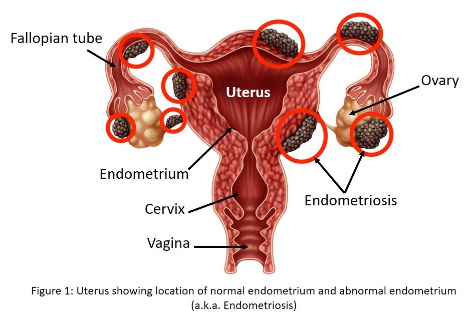Image showing different possible location of ectopic endometrium in the female reproductive organs.