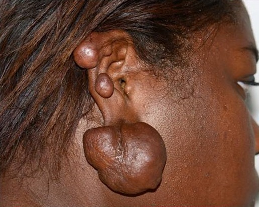 Woman ith right ear lobe keloids