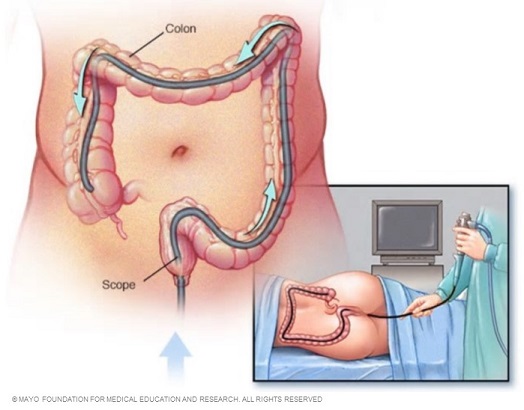Image showin procedure for colonoscopy with colonoscope in large bowel.