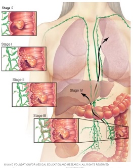 Image showing staging of colon cancer.