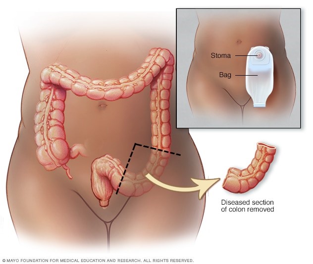 Imaage showing area of bowel resection in treatment of colon cancer