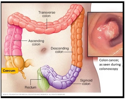 Image showing different parts of the colon. 