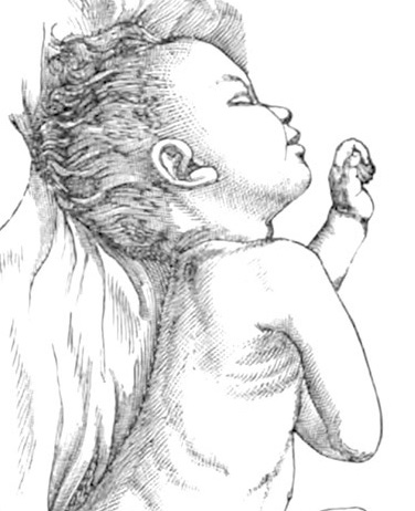 Illustration child with neck stiffness