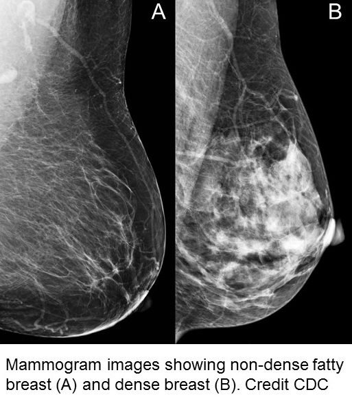 Mammogram images of the breast