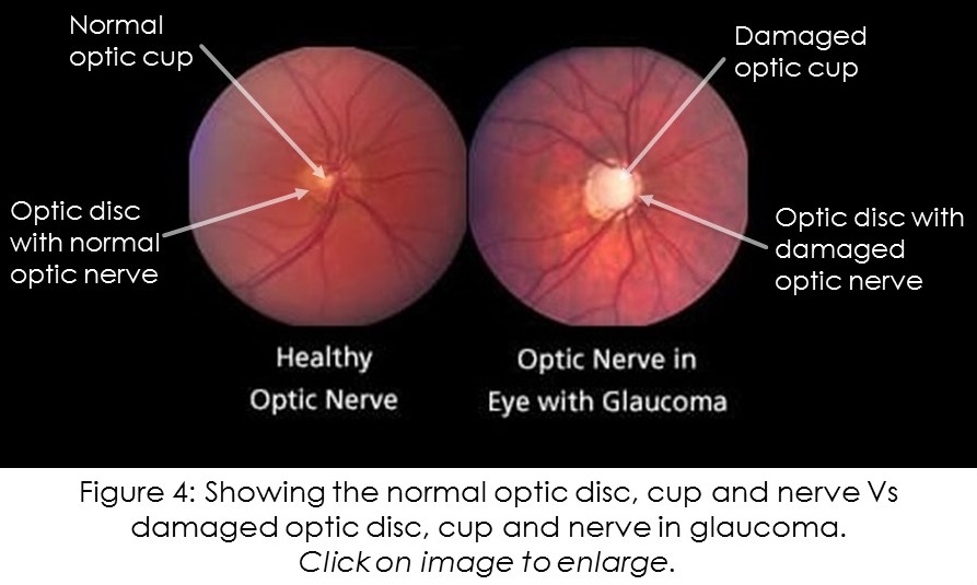Normal retina and optic disc vs Abnormal optic disc in glaucoma