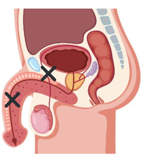 Post-testicular reproductive structures may also be affected by diabetes