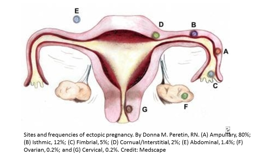 Drawing showing sites and frequencies of ectopic pregnancies.