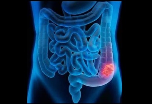 Cartoon illustration colon cancer