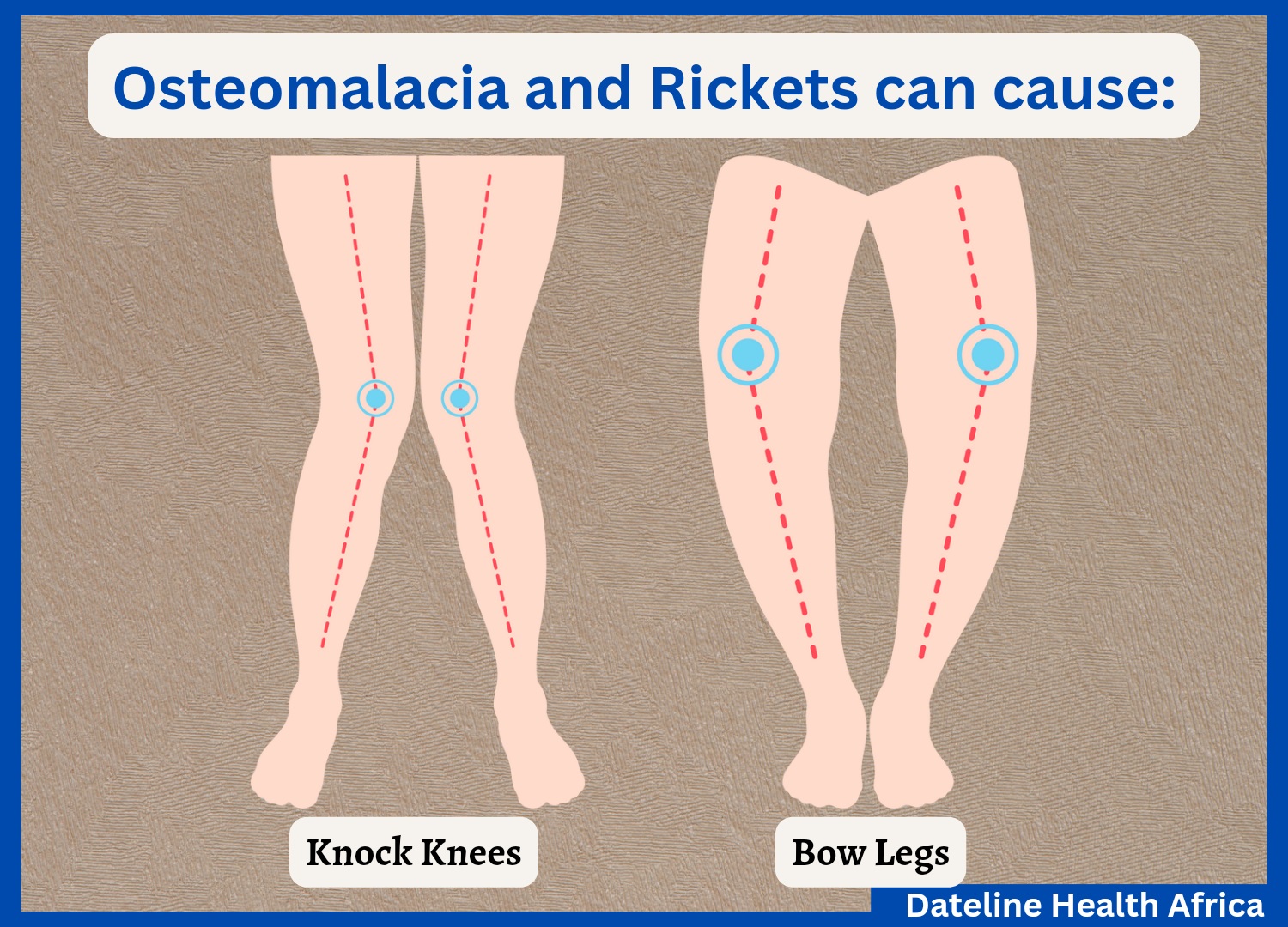 Osteomalacia and rickets causes bow legs and knock knees