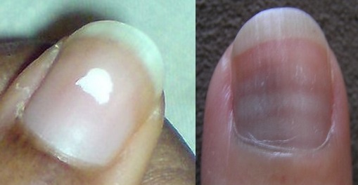 Everything Your Fingernails Are (Silently) Telling You About Your Health