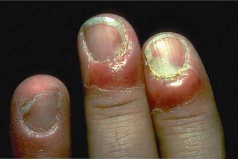 Nail Changes Associated With Thyroid Disease | MDedge Dermatology