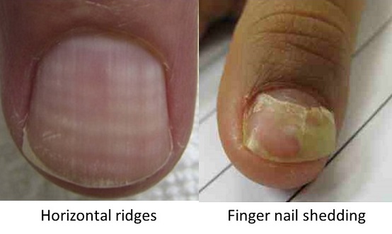 Ayurvedic Nail Analysis: What Your Nails Are Pointing to About Your Health