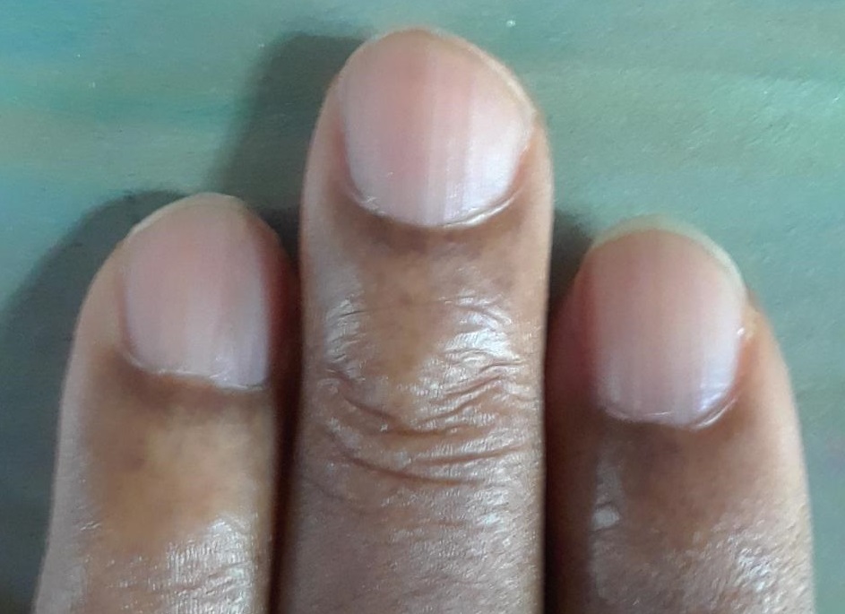 Missing Lunula ... NBNB Fascinating article saying that missing moons/orbs  on fingernails can mean underactive thy… | Fingernail health, Low energy  remedies, Health